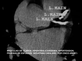 MASCULNO DE 70 AÑOS, HIPERTRIGLICERIDEMIA, HIPERTENSION,
PRUEBAS DE ESFUERZO NEGATIVAS CADA AÑO POR CINCO AÑOS
 