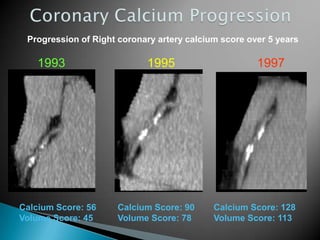 Calcium Score: 56 Calcium Score: 90 Calcium Score: 128
Volume Score: 45 Volume Score: 78 Volume Score: 113
1993 1995 1997
Progression of Right coronary artery calcium score over 5 years
 