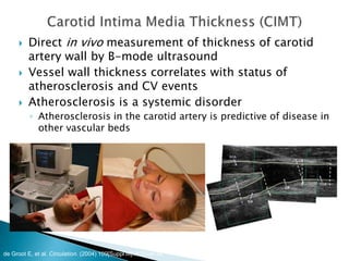  Direct in vivo measurement of thickness of carotid
artery wall by B-mode ultrasound
 Vessel wall thickness correlates with status of
atherosclerosis and CV events
 Atherosclerosis is a systemic disorder
◦ Atherosclerosis in the carotid artery is predictive of disease in
other vascular beds
de Groot E, et al. Circulation. (2004) 109[Suppl III]:III-33-III-38.
 