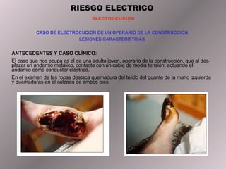 RIESGO ELECTRICO ELECTROCUCION CASO DE ELECTROCUCION DE UN OPERARIO DE LA CONSTRUCCION LESIONES CARACTERISTICAS ANTECEDENTES Y CASO CLÍNICO: El caso que nos ocupa es el de una adulto joven, operario de la construcción, que al des- plazar un andamio metálico, contacta con un cable de media tensión, actuando el andamio como conductor eléctrico. En el examen de las ropas destaca quemadura del tejido del guante de la mano izquierda y quemaduras en el calzado de ambos pies. 