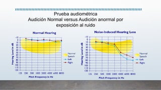 Prueba audiométrica
Audición Normal versus Audición anormal por
exposición al ruido
 