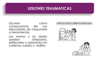 Ocurren como
consecuencia del uso
descuidado de maquinaria
o herramientas.
Las manos y los dedos
quedan atrapados,
pellizcados o aplastados en
cadenas, ruedas o rodillos.
LESIONES TRAUMATICAS
 