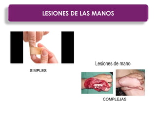 LESIONES DE LAS MANOS
SIMPLES
COMPLEJAS
 