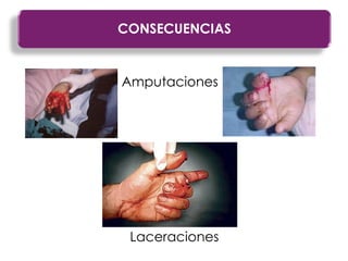 Amputaciones
CONSECUENCIAS
Laceraciones
 