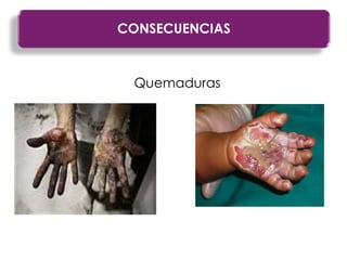 CONSECUENCIAS
Quemaduras
 