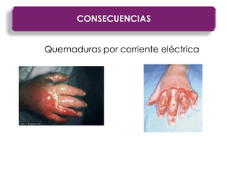 Quemaduras por corriente eléctrica
CONSECUENCIAS
 
