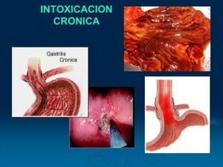 INTOXICACION
CRONICA
 