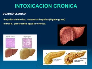 INTOXICACION CRONICA
CUADRO CLINICO
• hepatitis alcohólica, esteatosis hepática (hígado graso)
• cirrosis, pancreatitis aguda y crónica.
 