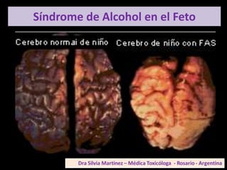 Síndrome de Alcohol en el Feto
 
