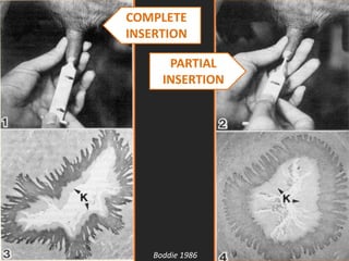 COMPLETE
INSERTION
PARTIAL
INSERTION
Boddie 1986
 