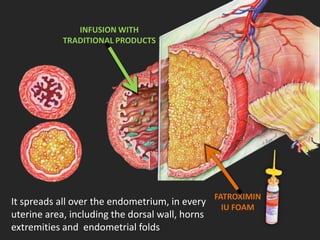 INFUSION WITH
TRADITIONAL PRODUCTS
FATROXIMIN
IU FOAM
It spreads all over the endometrium, in every
uterine area, including the dorsal wall, horns
extremities and endometrial folds
 