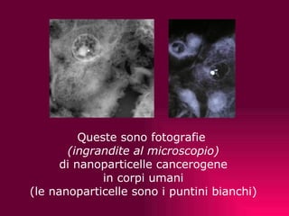   Queste sono fotografie  (ingrandite al microscopio) di nanoparticelle cancerogene in corpi umani (le nanoparticelle sono i puntini bianchi) 