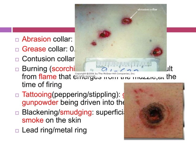 Hunting Rifle Injuries Rifled weapon injuries | PPT