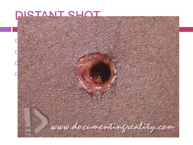 Rifled weapon injuries | PPTX | Arms & Ammunition | Sensitive Topics