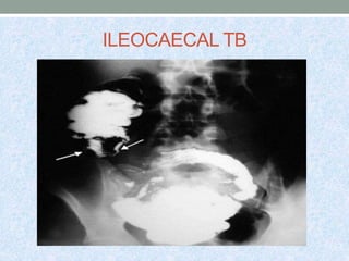 ILEOCAECAL TB
 