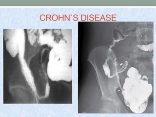 CROHN`S DISEASE
 