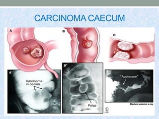 CARCINOMA CAECUM
 