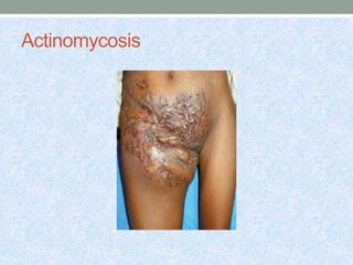 Actinomycosis
 