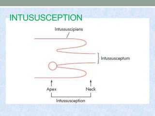 INTUSUSCEPTION
 