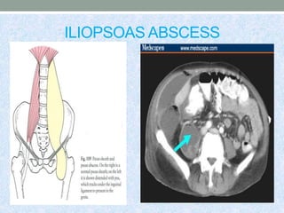 ILIOPSOAS ABSCESS
 