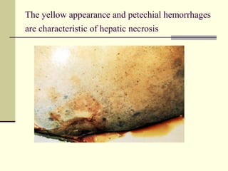 The yellow appearance and petechial hemorrhages
are characteristic of hepatic necrosis
 