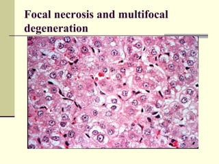 Focal necrosis and multifocal
degeneration
 