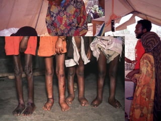 Programma nutrizionale

Sorveglianza nutrizionale :

  Precarietà ambientale e scarso accesso alle risorse alimentari causano
deperimento fisico e malattie a cominciare dai gruppi più deboli:
bambini < 5 anni e donne in gravidanza e allattamento.


  Riconoscimento delle persone malnutrite o a rischio di malnutrizione,
con metodo pro-attivo attraverso inchieste nutrizionali e valutazione dei
casi individuali :
-      Screening di gruppo: misurazione MUAC
-      Stato clinico individuale: rapporto Peso/Altezza – presenza Edemi
 