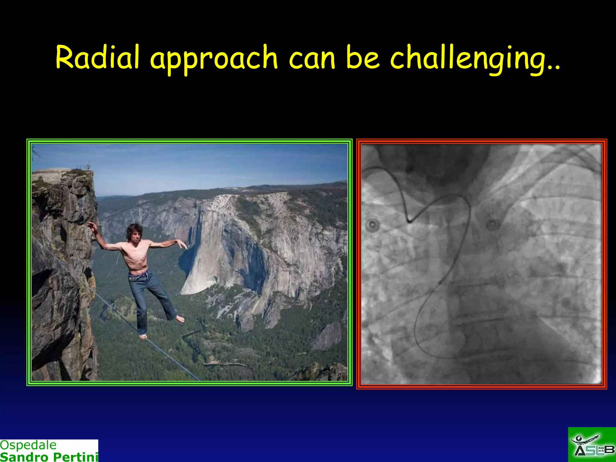 Radial approach can be challenging..

 