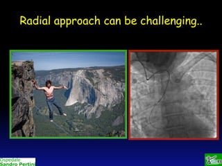 Radial approach can be challenging..

 