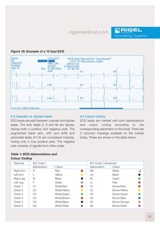 21
rigelmedical.com
Figure 19: Example of a 12 lead ECG
6.3 Unipolar vs. bipolar leads
ECG leads are split between unipolar and bipolar
leads. The limb leads (I, II and III) are bipolar,
having both a positive and negative pole. The
augmented leads (aVL, aVF and aVR) and
precordial leads (V1-6) are considered Unipolar,
having only a true positive pole. The negative
pole consists of signals from other poles.
6.4 Colour coding
ECG leads are marked with both abbreviations
and colour coding according to the
corresponding placement on the body. There are
2 common markings available on the market
today. These are shown in the table below.
Innovating Together
HR 62 bpm
14:37:18
QRS 0:112s
0.390s/0.395s
27 80 49
x1.0 .05-150Hz 25mm/sec
Name:
ID:
Patient ID
Incident:
Age: 26
12-Lead 2
hhh
PR0.138s
QT/QTc
P-QRS-Axes
aVR
Normal ECG **Unconfirmed**
Normal sinus rhythm
Sex:
o
o o o
o
lv1 lv4
lv5lv2l aVL
l aVF lv3 lv6
Table 1: ECG Abbreviations and
Colour Coding
Colour
White K
Black I
Green I
Red I
Brown/Red I
Brown/Yellow I
Brown/Green I
Brown/Blue I
Brown/Orange I
Brown/Violet I
Abbreviation
RA
LA
RL
LL
V1
V2
V3
V4
V5
V6
Colour
Red I
Yellow I
Black I
Green I
White/Red I
White/Yellow I
White/Green I
White/Brown I
White/Black I
White/Violet I
Abbreviation
R
L
N
F
C1
C2
C3
C4
C5
C6
Right Arm
Left Arm
Right Leg
Left Leg
Chest 1
Chest 2
Chest 3
Chest 4
Chest 5
Chest 6
Elecrode IEC Code 1 IEC Code 2 (American)
 