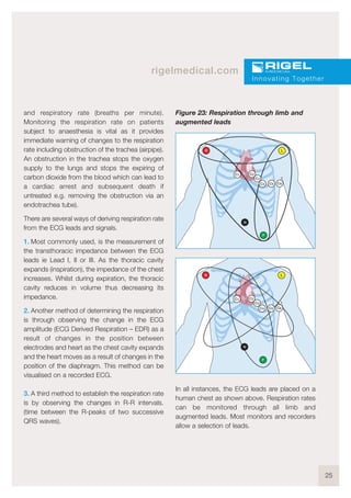 25
rigelmedical.com
and respiratory rate (breaths per minute).
Monitoring the respiration rate on patients
subject to anaesthesia is vital as it provides
immediate warning of changes to the respiration
rate including obstruction of the trachea (airpipe).
An obstruction in the trachea stops the oxygen
supply to the lungs and stops the expiring of
carbon dioxide from the blood which can lead to
a cardiac arrest and subsequent death if
untreated e.g. removing the obstruction via an
endotrachea tube).
There are several ways of deriving respiration rate
from the ECG leads and signals.
1. Most commonly used, is the measurement of
the transthoracic impedance between the ECG
leads ie Lead I, II or III. As the thoracic cavity
expands (inspiration), the impedance of the chest
increases. Whilst during expiration, the thoracic
cavity reduces in volume thus decreasing its
impedance.
2. Another method of determining the respiration
is through observing the change in the ECG
amplitude (ECG Derived Respiration – EDR) as a
result of changes in the position between
electrodes and heart as the chest cavity expands
and the heart moves as a result of changes in the
position of the diaphragm. This method can be
visualised on a recorded ECG.
3. A third method to establish the respiration rate
is by observing the changes in R-R intervals.
(time between the R-peaks of two successive
QRS waves).
Figure 23: Respiration through limb and
augmented leads
In all instances, the ECG leads are placed on a
human chest as shown above. Respiration rates
can be monitored through all limb and
augmented leads. Most monitors and recorders
allow a selection of leads.
Innovating Together
R
N
L
C1 C2
C3
C4 C5 C6
F
R
N
L
C1 C2
C3
C4 C5 C6
F
 