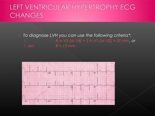 › To diagnose LVH you can use the following criteria*:

 avL

R in V5 (or V6) + S in V1 (or V2) > 35 mm, or
R > 13 mm

 