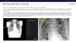 UX DISCOVERY NO.10 UX TREND
SOURCE :
3. HEALTHCARE SERVICE
흉부 X-ray 자동 해석 시스템, qXR
qXR은 딥 러닝 기술을 통해 흉부 X-ray에서 비정상적인 결과를 감지할 수 있는 Qure.ai의 소프트웨어이다.
360만 개 이상의 데이터베이스를 사용하여 훈련되고 테스트된 qXR은 총 29개의 결과를 감지할 수 있는 알고리즘을 내장하고 있다. 이것을 통해 코로나19 감염 가능성도
포착할 수 있으며, 폐, 흉막, 심장, 뼈 및 횡경막에 대한 여러 소견을 감지하고 표시해준다. 동일한 환자의 스캔을 순차적으로 분석하여 시간 경과에 따른 병변의 변화도
감지해낼 수 있다.
코로나19 상황에서 한국으로 세계의 이목이 집중된 이유 중 하나가 바로 신속한 검사가 가능한 진단키트이다. 그만큼 치료제 및 백신이 없는 바이러스 확산 상황에서 진
단 시간을 단축시키는 일은 매우 중요한 사항이다. 그런 관점에서 볼 때, 데이터가 쌓이면 쌓일수록 더욱 정교화 되어지는 AI를 통해 진단의 가속화를 이루려는 이 시도
는 매우 유용하고도 중요한 시도이다. 다만, 질병 가능성 수치에 따라 어떠한 후속 조치들이 이뤄져야 할지에 대한 명확한 기준이 마련되어 의사들마다 본 시스템의 결과
를 다르게 해석하고 처리하는 혼란이 일어나지 않도록 할 필요가 있다.
QURE.AI
 