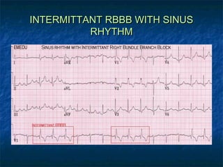 INTERMITTANT RBBB WITH SINUS
RHYTHM