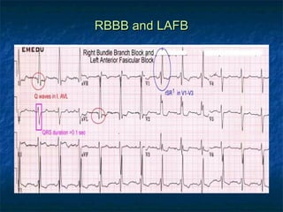 RBBB and LAFB