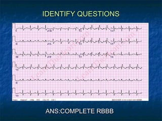 IDENTIFY QUESTIONS
ANS:COMPLETE RBBB