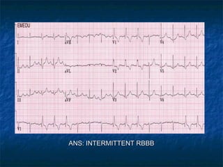 ANS: INTERMITTENT RBBB