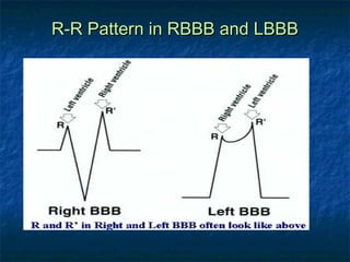 R-R Pattern in RBBB and LBBB