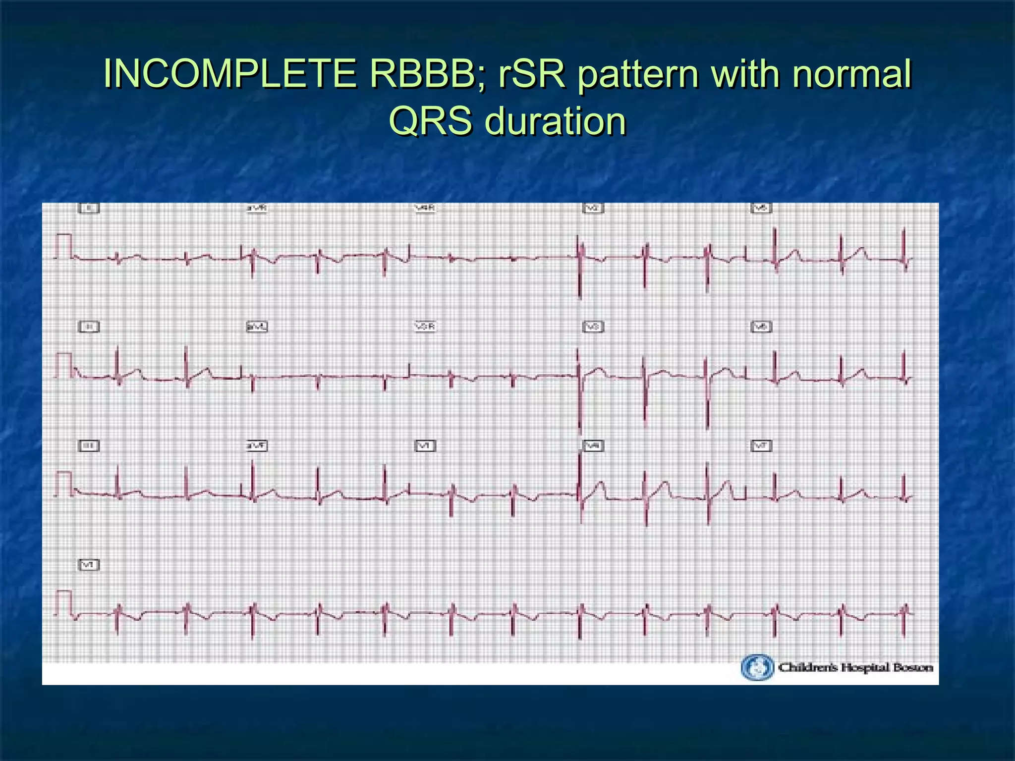 INCOMPLETE RBBB; rSR pattern with normal
QRS duration

 