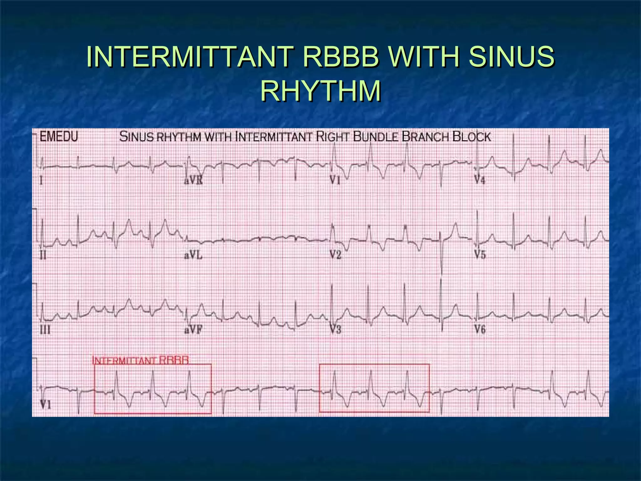 INTERMITTANT RBBB WITH SINUS
RHYTHM

 