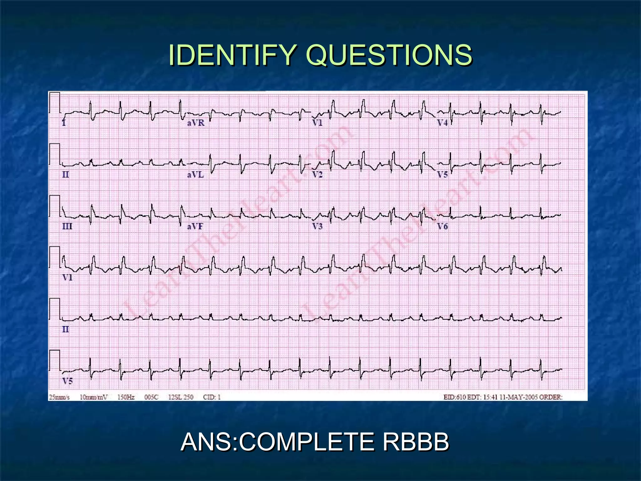 IDENTIFY QUESTIONS

ANS:COMPLETE RBBB

 