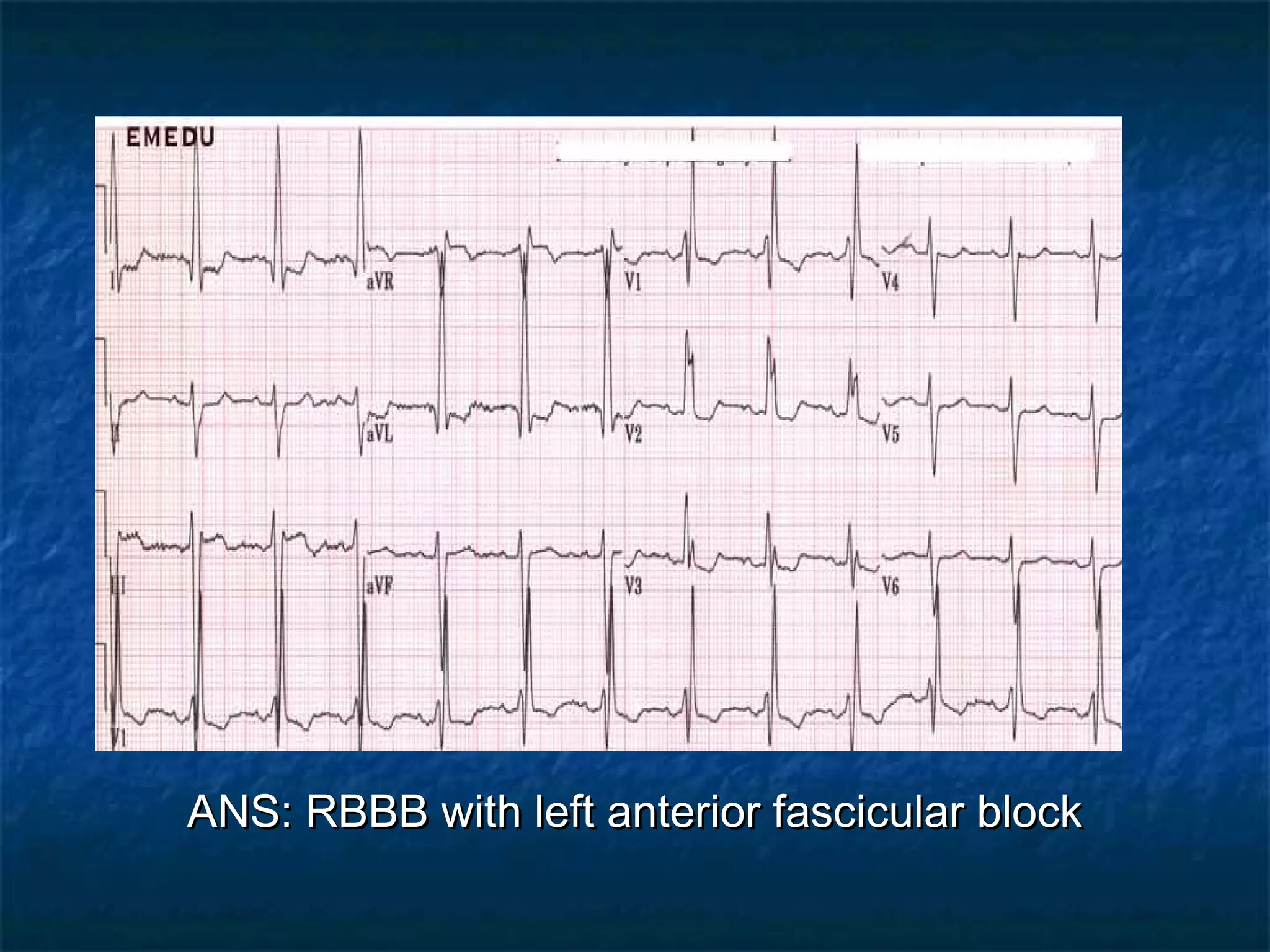 ANS: RBBB with left anterior fascicular block

 