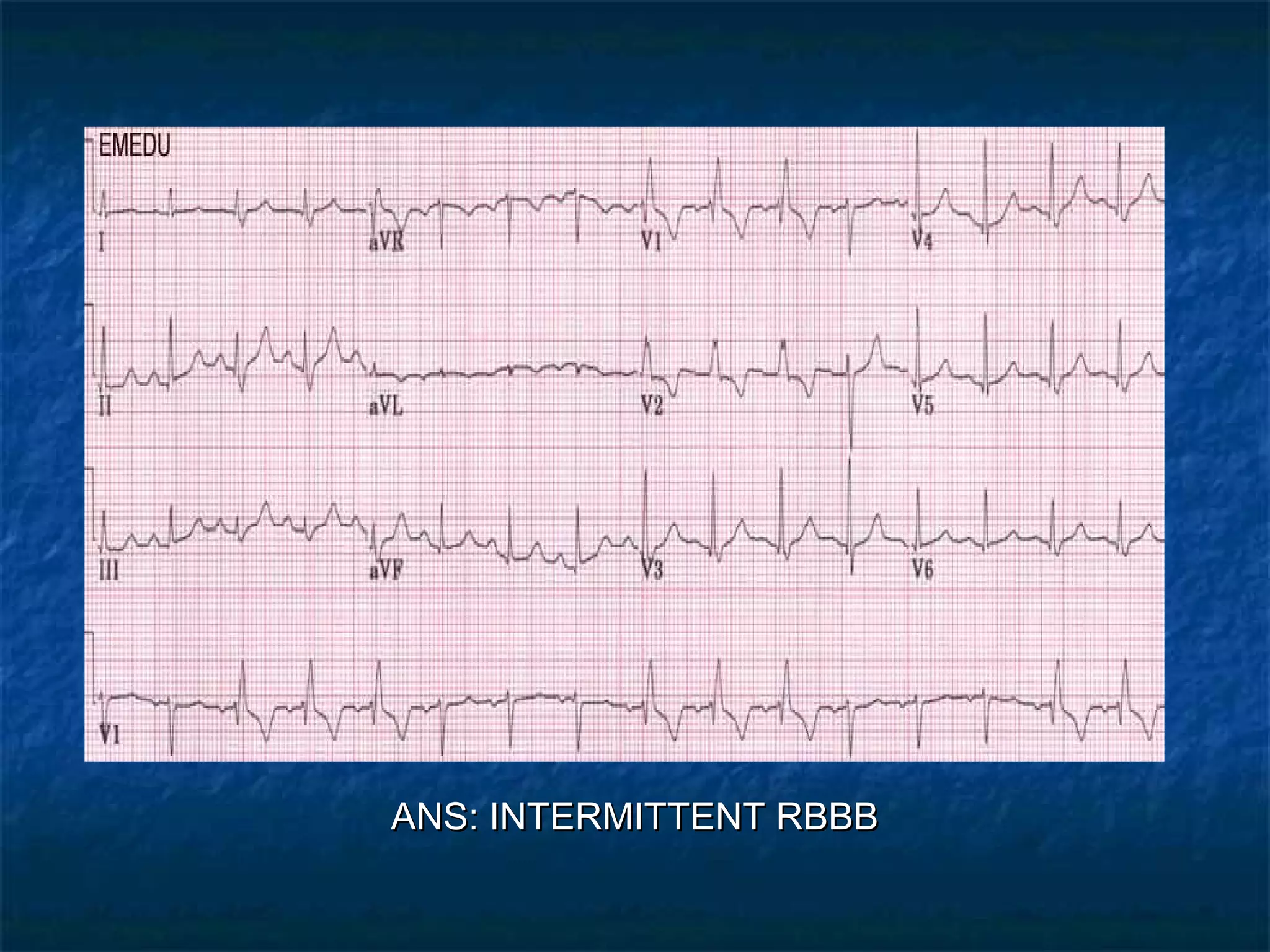 ANS: INTERMITTENT RBBB

 