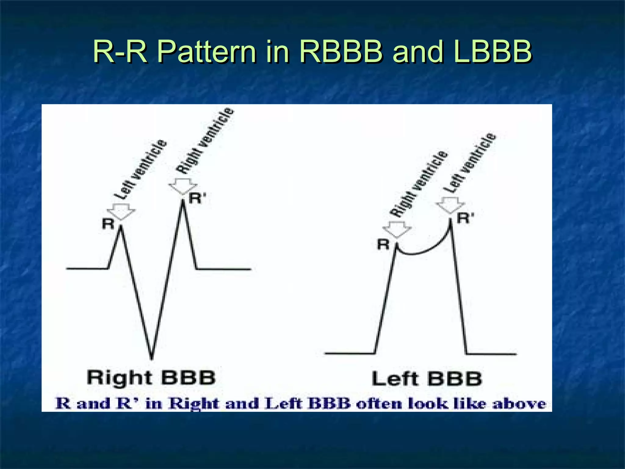 R-R Pattern in RBBB and LBBB

 