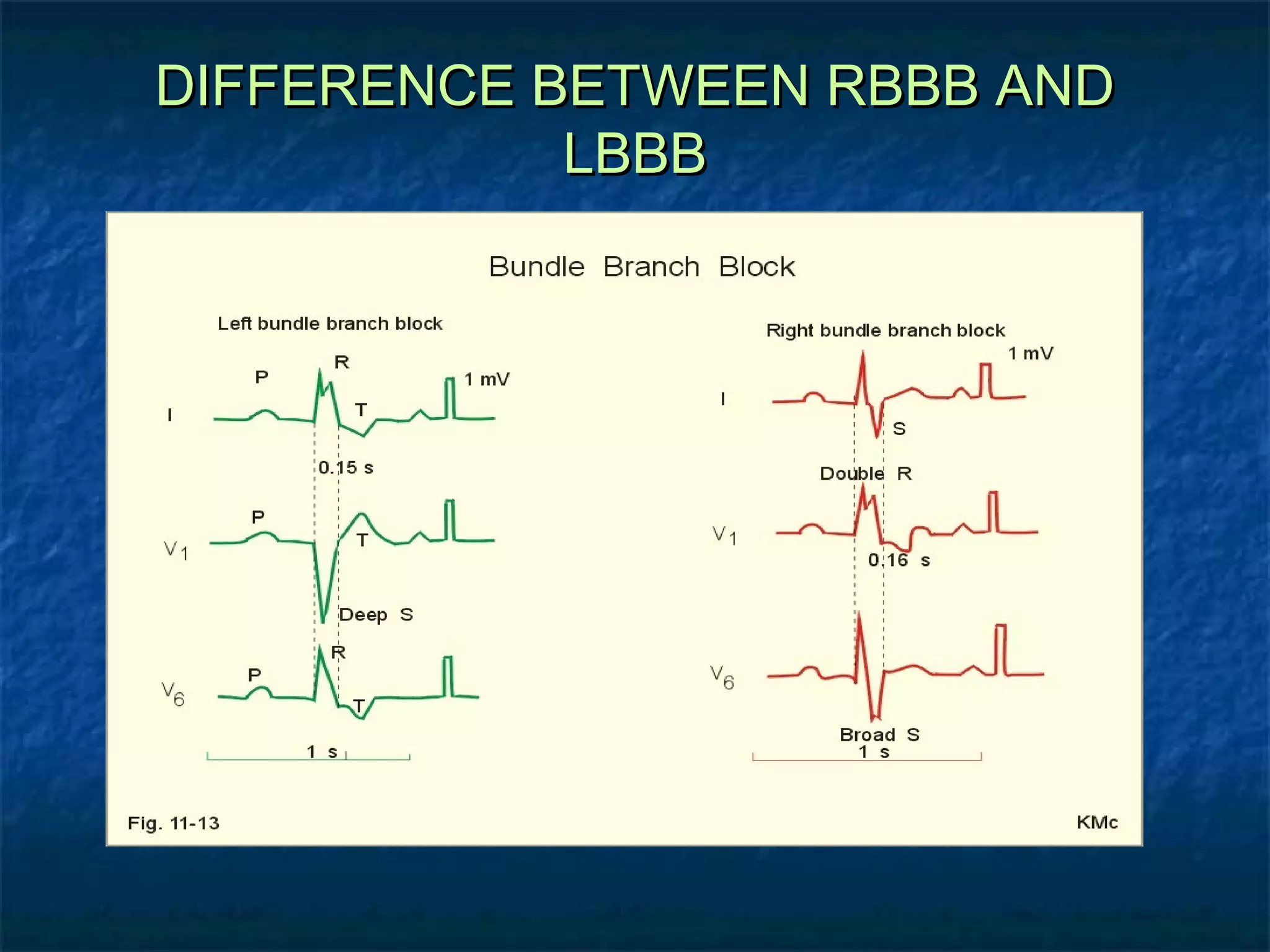 DIFFERENCE BETWEEN RBBB AND
LBBB

 