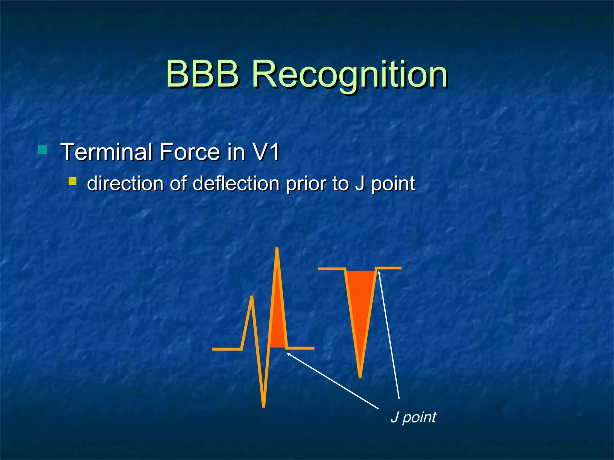 BBB Recognition


Terminal Force in V1


direction of deflection prior to J point

J point

 