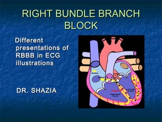 RIGHT BUNDLE BRANCH
BLOCK
Different
presentations of
RBBB in ECG
illustrations

DR. SHAZIA

 