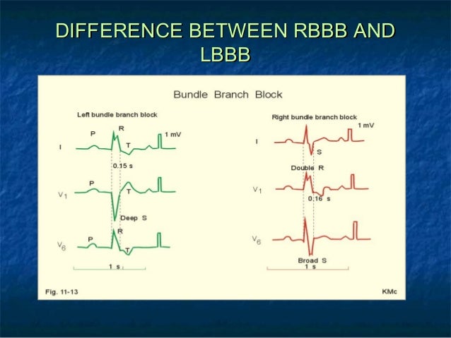 Right bundle branch block