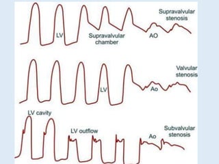 Rhc Waveforms RIGHT HEART CATHETERISATION 2.pptx