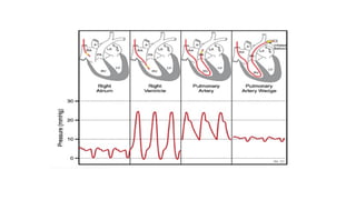 Rhc Waveforms RIGHT HEART CATHETERIZATION (RHC) STUDY.pptx